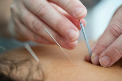 Acupuncture in Epsom