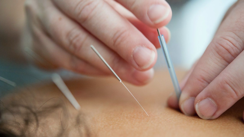 Acupuncture in Epsom