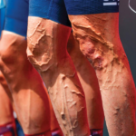 varicose veins in Sydney