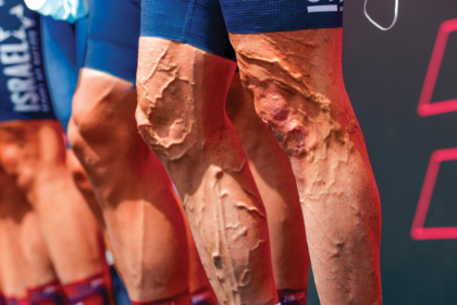 varicose veins in Sydney