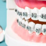 Braces in Victoria
