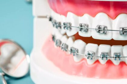 Braces in Victoria