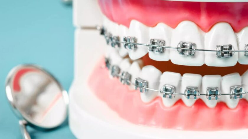 Braces in Victoria