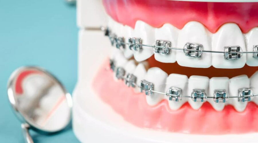 Braces in Victoria