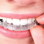 Invisalign dentist in Ottawa