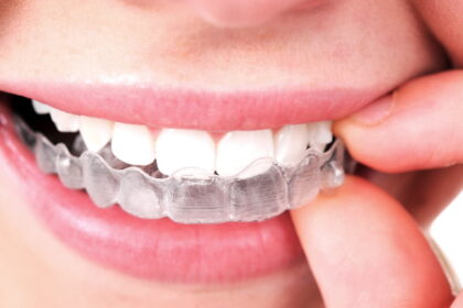 Invisalign dentist in Ottawa