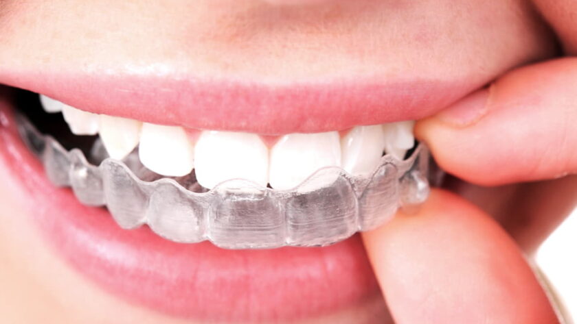 Invisalign dentist in Ottawa
