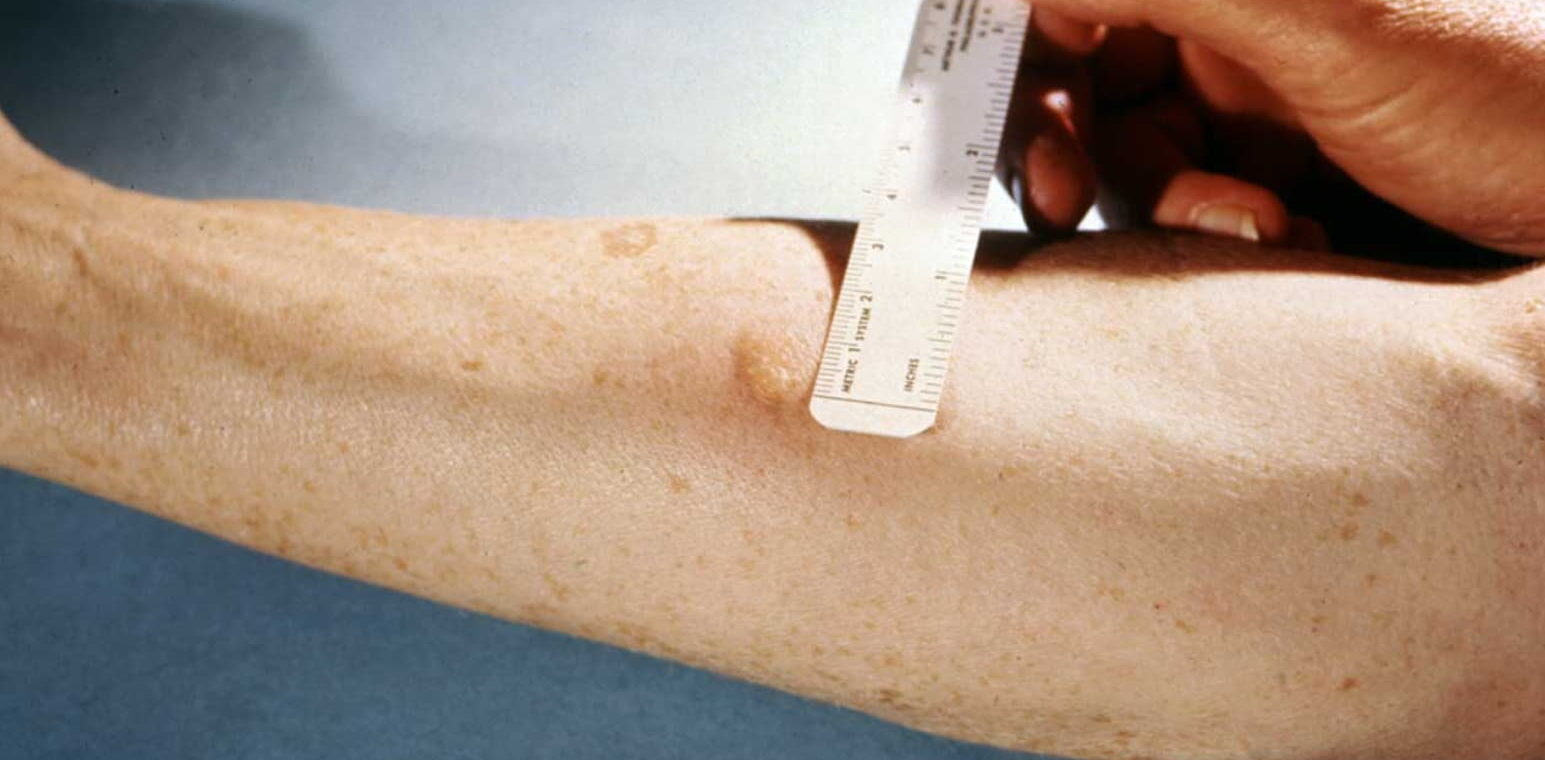 TB skin test