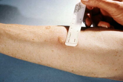 TB skin test