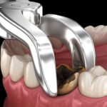 Wisdom teeth extraction