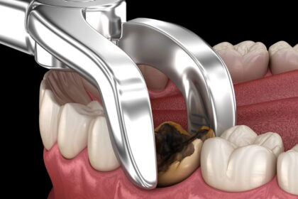 Wisdom teeth extraction