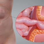hernias surgery on the Gold Coast