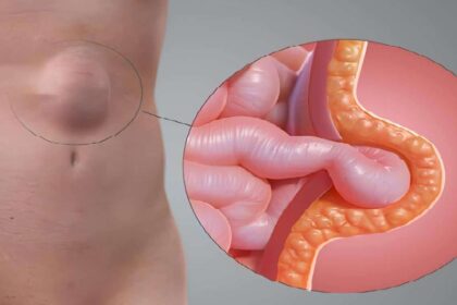 hernias surgery on the Gold Coast