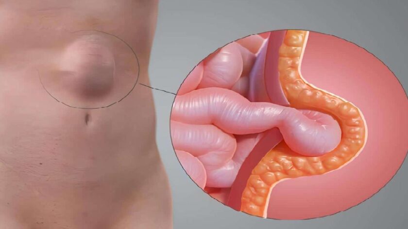 hernias surgery on the Gold Coast